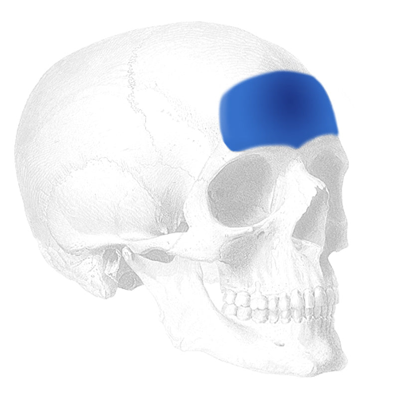 Implantech ePTFE Forehead Implant
