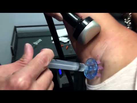 Mesoram Circular 7 Mesotherapy Needle Multi Injectors - Box of 36 Units