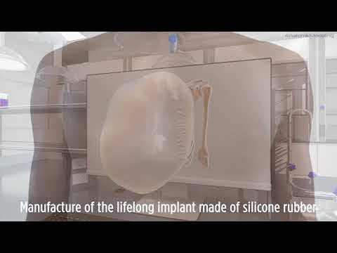 3D Custom Made Implants For Pectus Excavatum (and Poland Syndrome) by AnatomikModeling