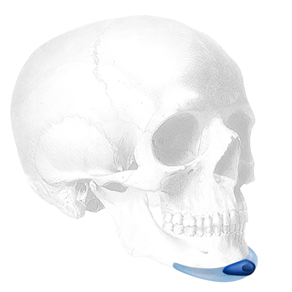 Implantech Glasgold Wafer™ for the Mandibular Pre-Jowl Chin™ Implant