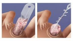 Bentec Ventral Wall Defect Silo Bags