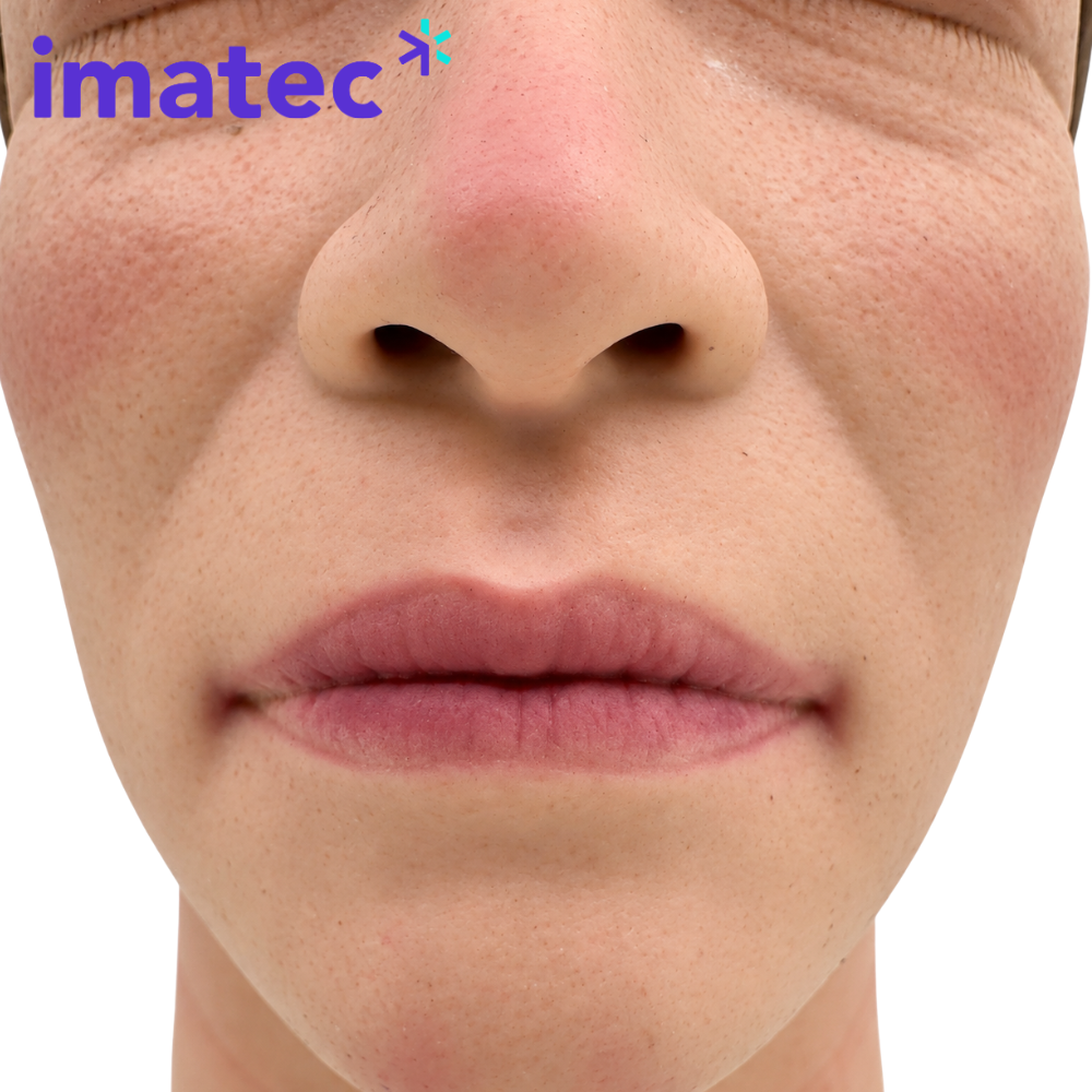 Facial Injection Training Head by Imatec Medical