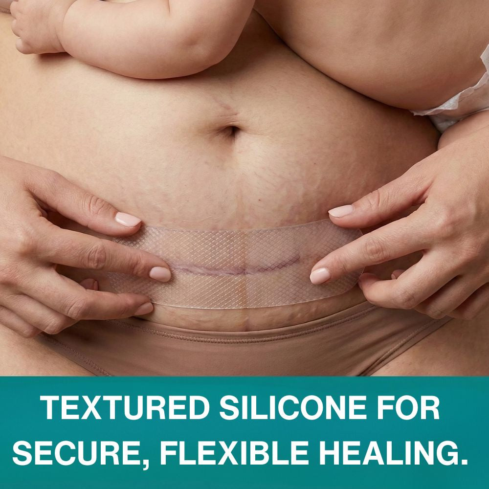 Restore Silicone Scar Sheet (150mmx15mm) by Imatec Medical