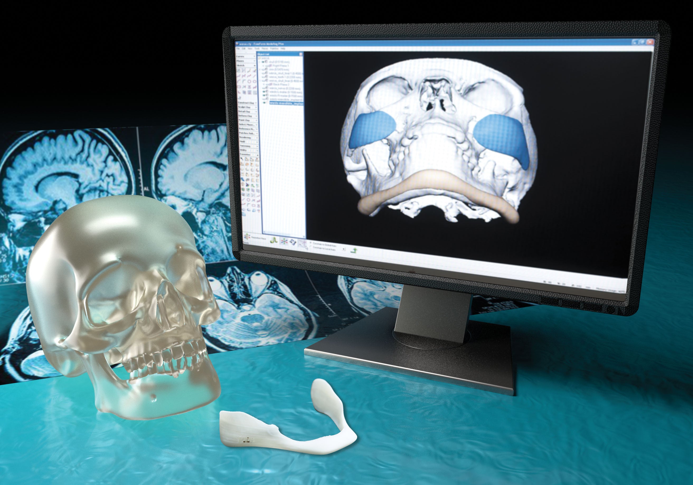 Implantech 3d Accuscan Patient Specific Custom Implants