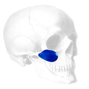 Implantech Conform™ Midfacial Implant (Sold in Pairs)