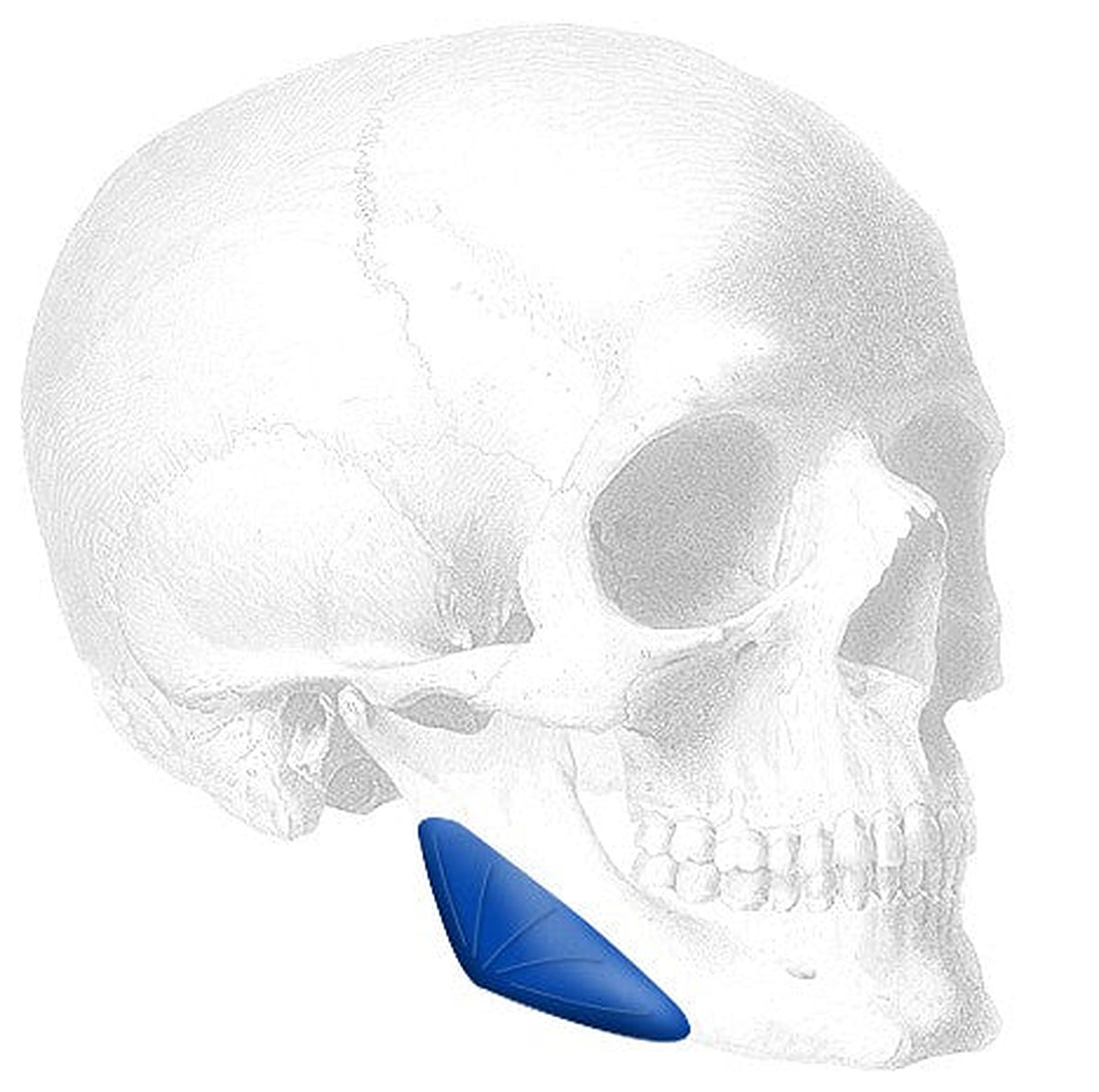 Implantech Widening Mandibular Angle Implant