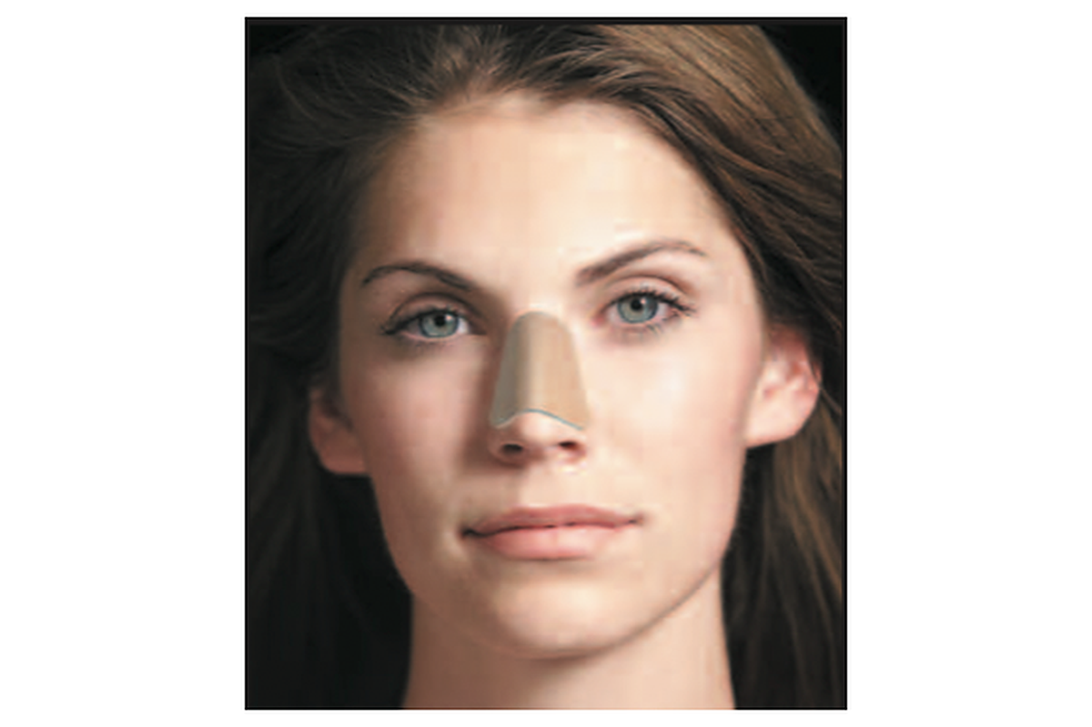 Denver Nasal Splint Kit - Two Piece Velcro - Box of 5 | Precise Medical