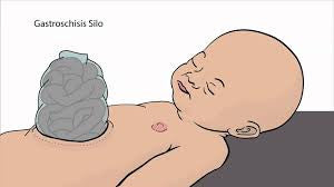 Bentec Ventral Wall Defect Silo Bags